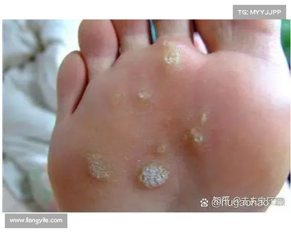 足底疣:治疗与性传播关系? 足底疣:治疗与性传播关系?